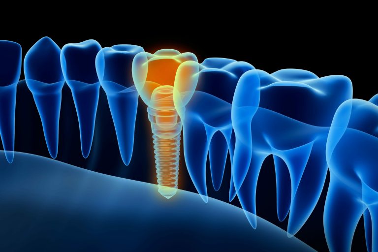 dental implant calgary nw